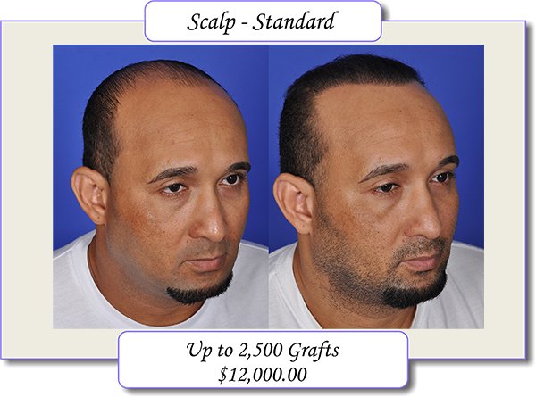 price for 2500 smartgraft hair transplants