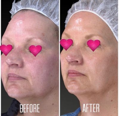 skin rejuvenation before and after on a 56 year old patient