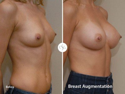 Breast Augmentation - before and after