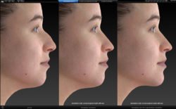 nose and chin augmentation