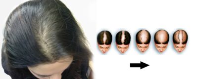 Hair Transplants & Hair Restoration Hair Transplants & Hair Restoration