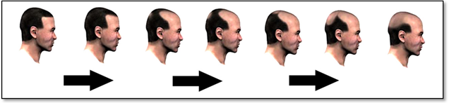 hair loss in men